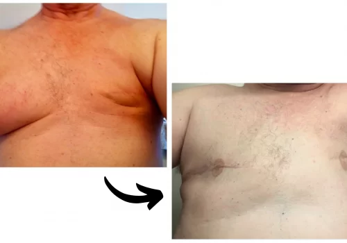 Before and after the cutting of breasts