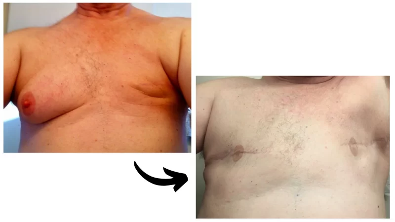 Before and after the cutting of breasts